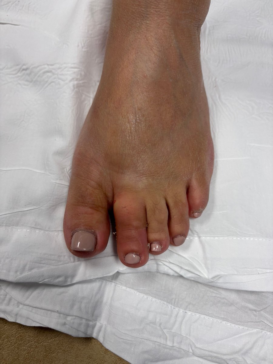Janetbirdope's tweet photo. What is the diagnosis?
#diagnosis in 1 #picture
Hint - most common #dx
For #toe #dactylitis https://t.co/3XiFZT7Ncy