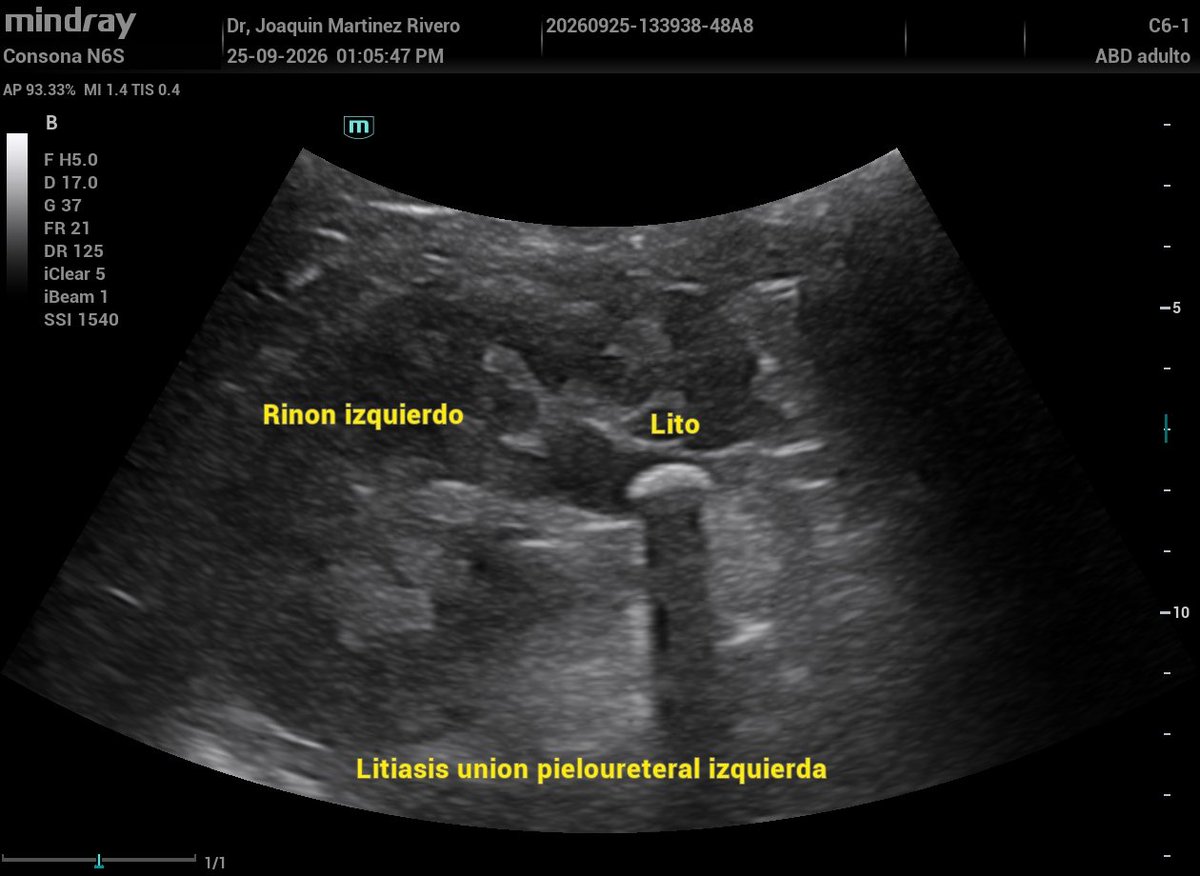 JMMR83's tweet photo. Litiasis unión pieloureteral izquierda. https://t.co/PhTUkHmF09