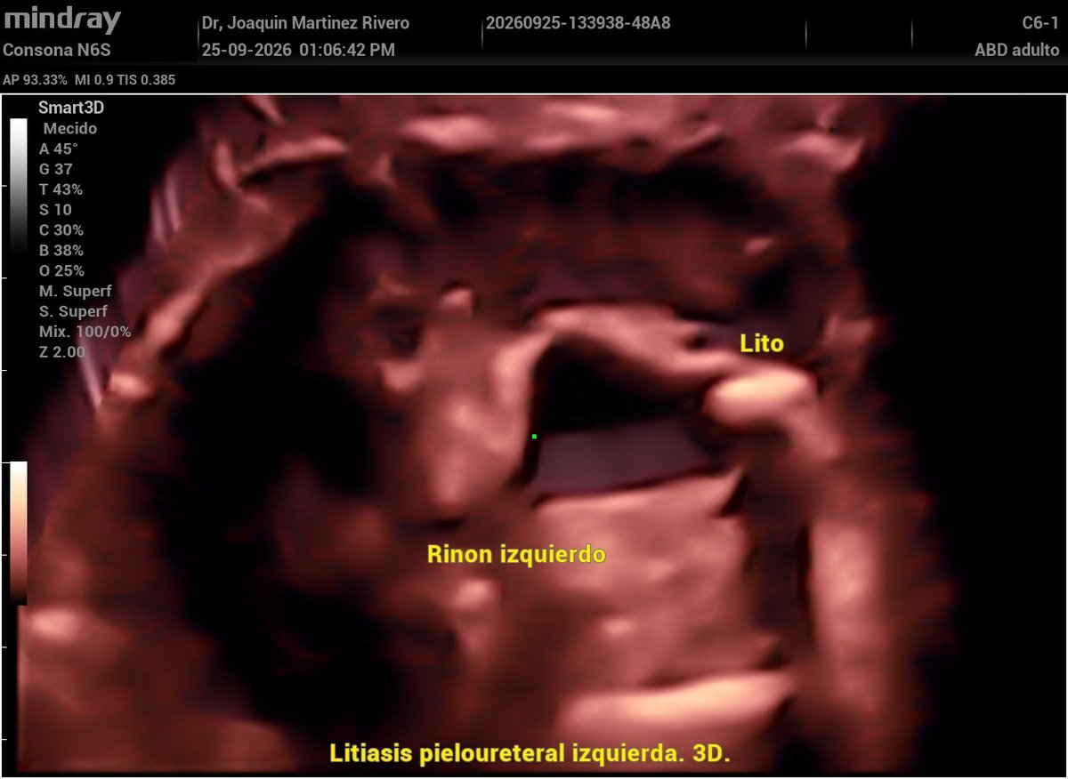 JMMR83's tweet photo. Litiasis unión pieloureteral izquierda. https://t.co/PhTUkHmF09