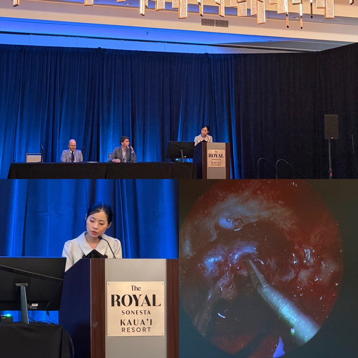 jerjohnson's tweet photo. Great presentation today by @lilykim_md from @StanfordNsurg at the @WestNsurg meeting on endoscopic transnasal resection for tumors invading the cavernous sinus #WestNsurg2026 https://t.co/PYzfw93AW1