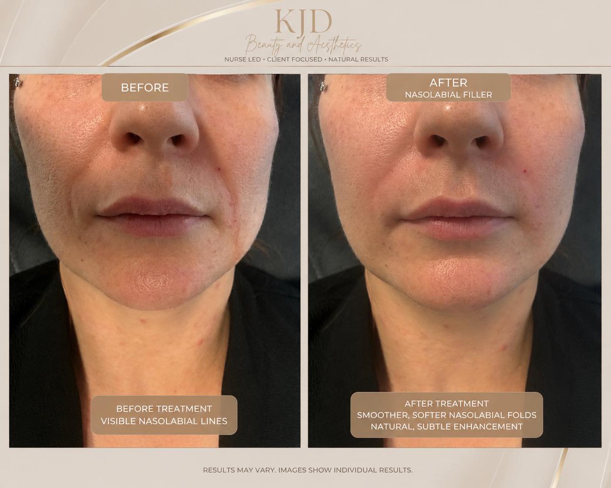 VivianaPlotnik's tweet photo. Nasolabial filler can soften deeper folds, restore subtle volume, and refresh the lower face while preserving natural movement. At KJD Beauty and Aesthetics, every treatment is tailored to your facial anatomy. Chorley | Nurse-led aesthetics | https://t.co/lLtyyTxLWg