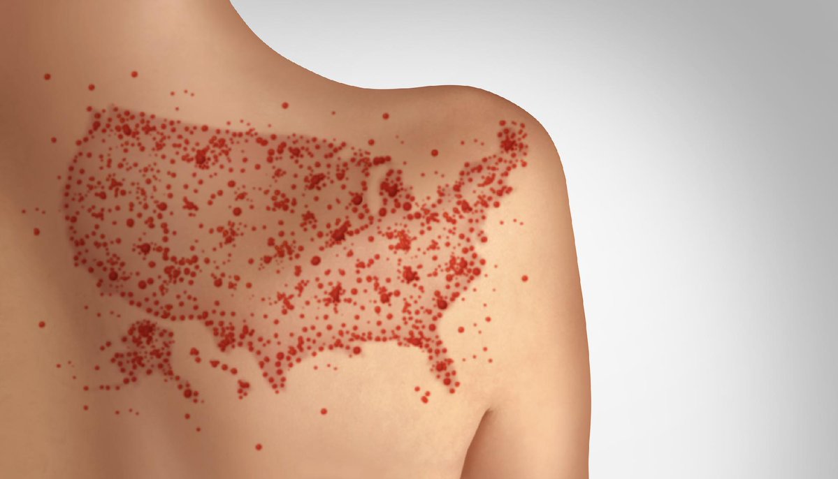 CIDRAP's tweet photo. US measles cases continue to climb, topping 3,600

Today, the CDC reported 171 new confirmed measles cases, bringing the year’s total to 3,659. 

Read more: https://t.co/phF2A7CaZ6 https://t.co/LEMArfBhMW