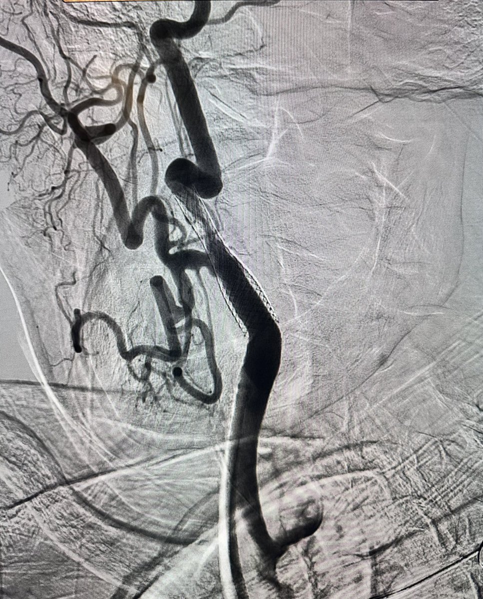 jcgeorgemd's tweet photo. Highlighting the importance of multiple views and intravascular imaging in carotid angiography and how overlap and shadowing can mask true anatomical lesions…..here’s a patient that had significant instent restenosis on US but negated by initial angio, until…..
#IVUS #CAS https://t.co/AA2tPZHbxR