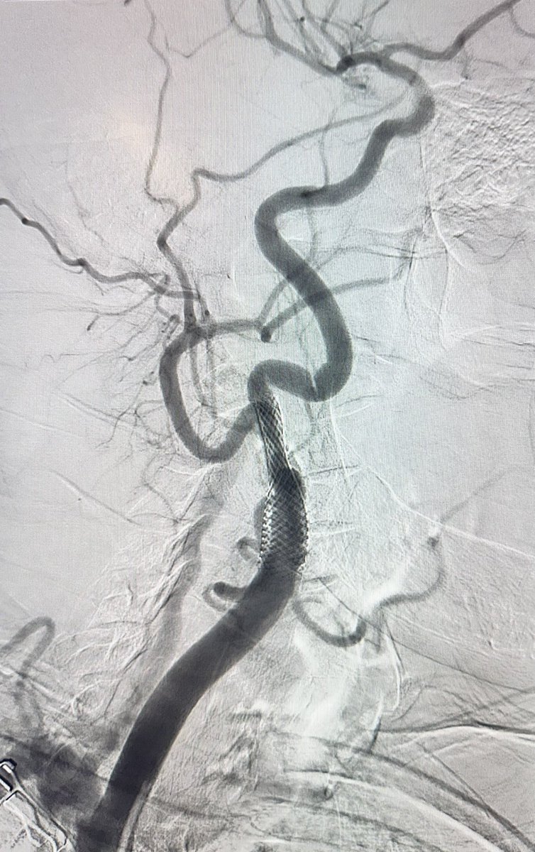 jcgeorgemd's tweet photo. Highlighting the importance of multiple views and intravascular imaging in carotid angiography and how overlap and shadowing can mask true anatomical lesions…..here’s a patient that had significant instent restenosis on US but negated by initial angio, until…..
#IVUS #CAS https://t.co/AA2tPZHbxR