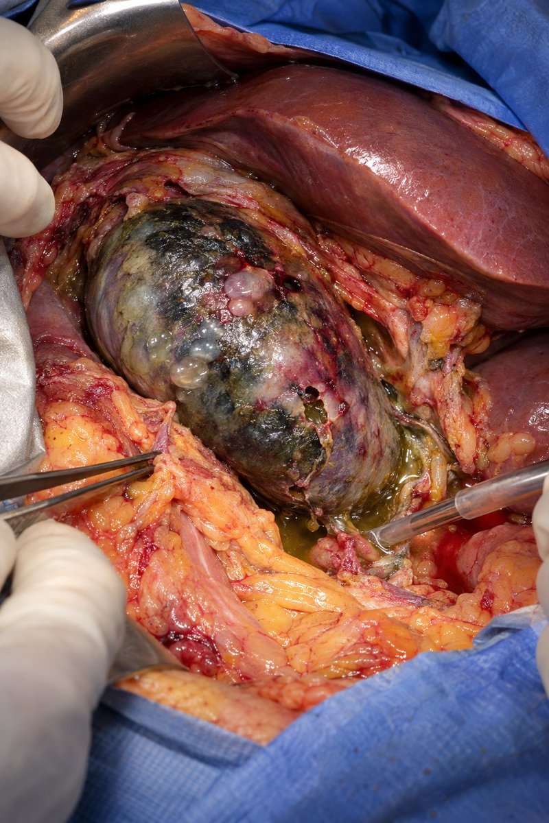 IhabFathiSulima's tweet photo. What has happened to the Gall Bladder? https://t.co/u2H7pvhCTi
