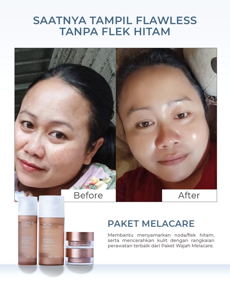 WondaGleitr5dk's tweet photo. Dengan pemakaian rutin Paket Melacare, kulit tampak lebih cerah merata, noda hitam tersamarkan, dan tekstur terasa lebih halus serta sehat bercahaya. Rawat kulit, pancarkan versi terbaikmu bersama MK SKIN. https://t.co/c02sLm5gZ7
