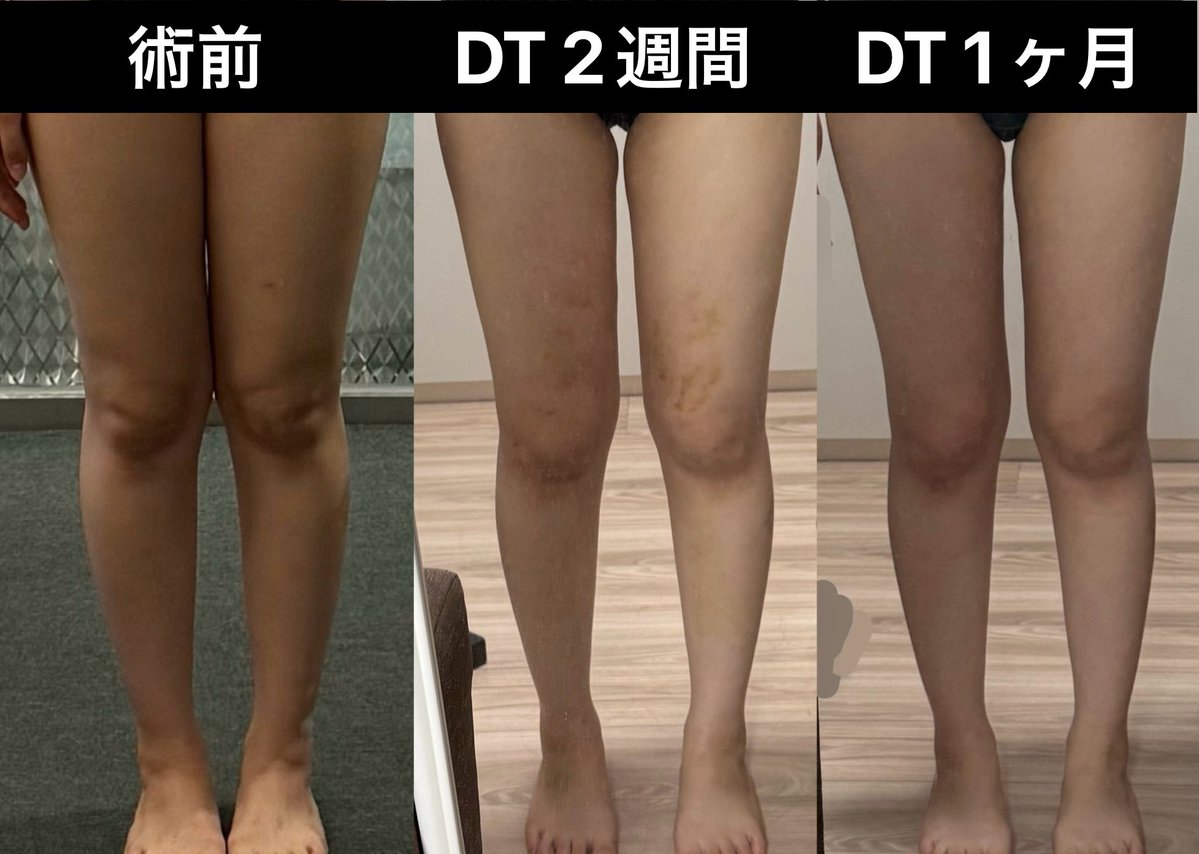 ixntqn's tweet photo. 🇰🇷 ラビチェ医院

DT1ヶ月経過
日常生活に支障なし💯
内出血も消えて拘縮がすこし残ってます
拘縮はインディバをやめてハイパーナイフあてたら明らかに柔らかくなりました⊂(ᴖ ̫ᴖ  )⊃

術前インディバ×1 (3日前)
術後インディバ×2
術後ハイパーナイフ×2

#太もも脂肪吸引 #ふくらはぎ脂肪吸引 https://t.co/Kdv5asr9ns