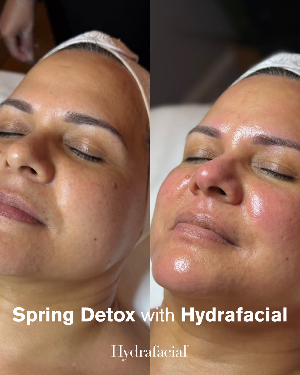 johnlopezshs141's tweet photo. Spring Detox with Hydrafacial

Refresh your skin after winter with a fully customised Hydrafacial. Choose targeted boosters for deep cleansing, hydration, brightening, calming or anti-ageing support. Add Lymphatic Therapy to reduce puffiness and https://t.co/AqAPDX71vL