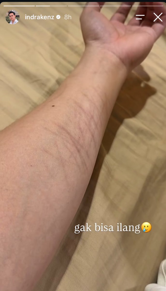 bardanslm's tweet photo. dulu dony salmanan keluar penjara dapet ratusan juta dari exclusive karna mau cerita sesuatu. 

sekarang indra kenz di storynya liatin bekas luka di bagian lengan bawah, dan mau cerita hanya untuk di live exclusive. 

enak yak jd influencer keluar tahanan auto bisa dapet ratusan juta dari exclusive. 

apakah sebenarnya ini kunci sukses??? 🙏🏻🙏🏻🙏🏻