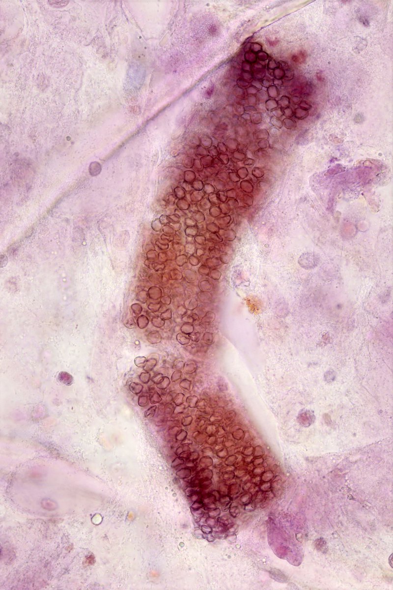jrseltzer's tweet photo. RBC cast - brightfield with SM stain - from pt with newly diagnosed SLE and APLS - #UrinarySediment #UrineMicroscopy https://t.co/CrN6wbZoRs