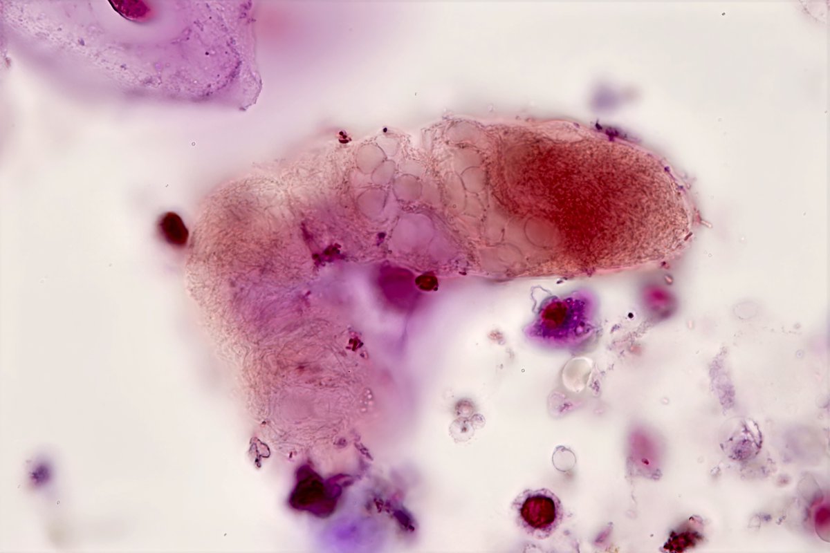 jrseltzer's tweet photo. Fibrin cast containing RBC's - brightfield with SM stain - from pt with newly diagnosed SLE and APLS - #UrinarySediment #UrineMicroscopy https://t.co/7bD6hebamR