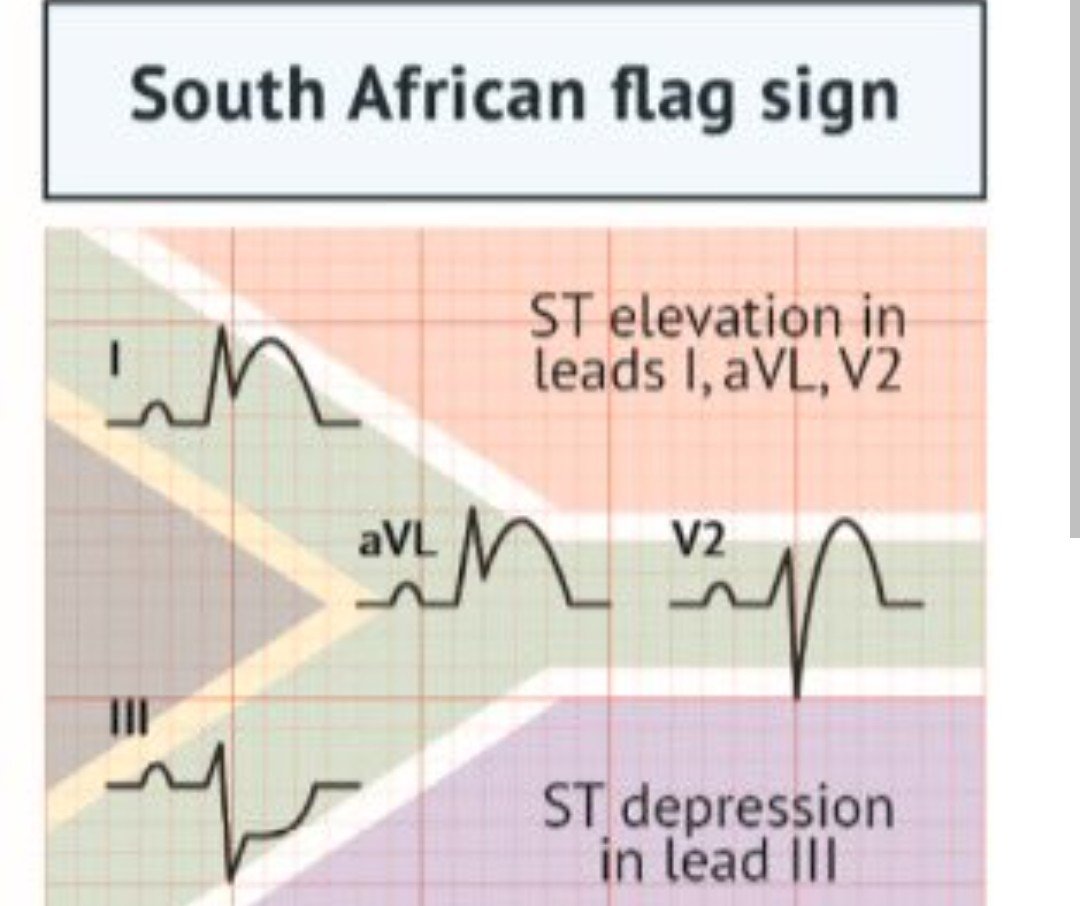 nevuslp's tweet photo. @jvillacastin Patrón de electrocardiograma que urge  Hemodinamia CCG por IAMCEST signo de la bandera de Sudáfrica https://t.co/XJldeYRrwk