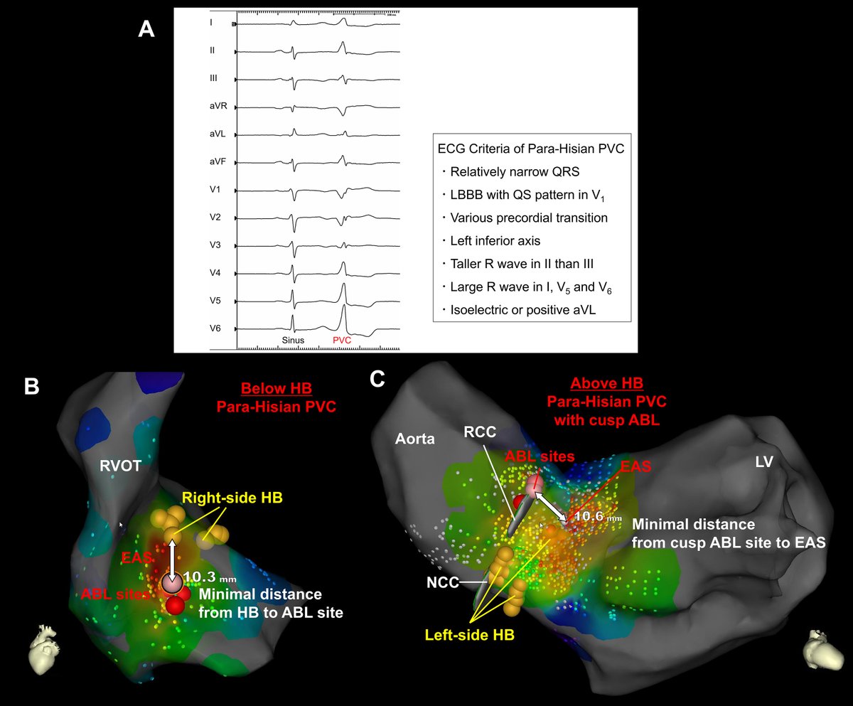 hrs_journal's tweet photo. Anatomical Approach from Aortic Sinus of Valsalva for Para-Hisian Premature Ventricular Contractions: Safety and Outcomes #OpenAccess

https://t.co/WOd74fontQ https://t.co/ar1CZwQtpA