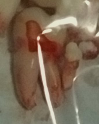 Frostimaw's tweet photo. Wisdom teeth have been extracted. Alongside a random baby tooth that just decided to show up one day. here is a size comparison between a wisdom tooth and this "random kid" ass tooth https://t.co/ZKchbWhYs6