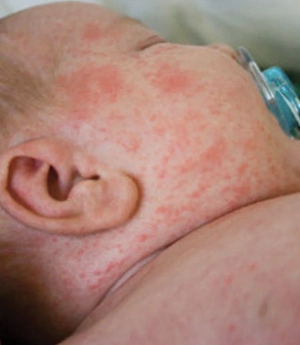 RealDrJaneRuby's tweet photo. BORN INFECTED WITH MEASLES - Because The Mother Was Coerced To Take @Merck’s  LIVE Shot While Pregnant https://t.co/QZrRNfnU6T