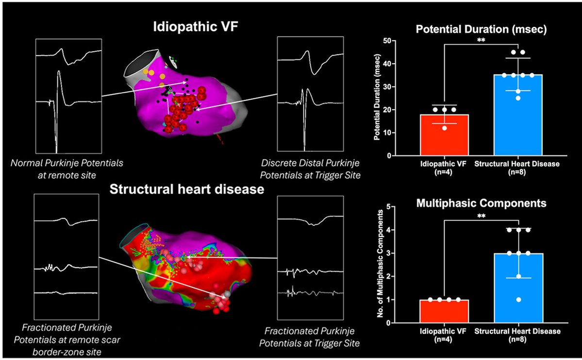 hrs_journal's tweet photo. Distinct Purkinje electrogram phenotypes at ventricular fibrillation trigger sites in idiopathic and structural heart disease

@RobNKerley

https://t.co/azy2IoqhMc https://t.co/65l9VUo2ch