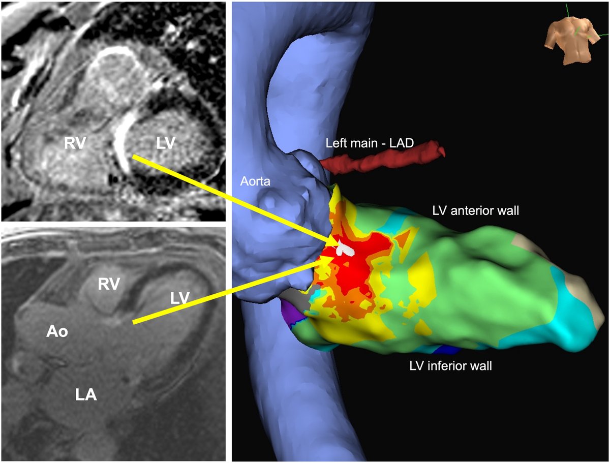 hrs_journal's tweet photo. Para-His periaortic VT ablation with focal pulsed-field energy #OpenAccess

@PranavBhagirath @IVRoca

https://t.co/xrMD60Hri7 https://t.co/jJ4K2fxppq