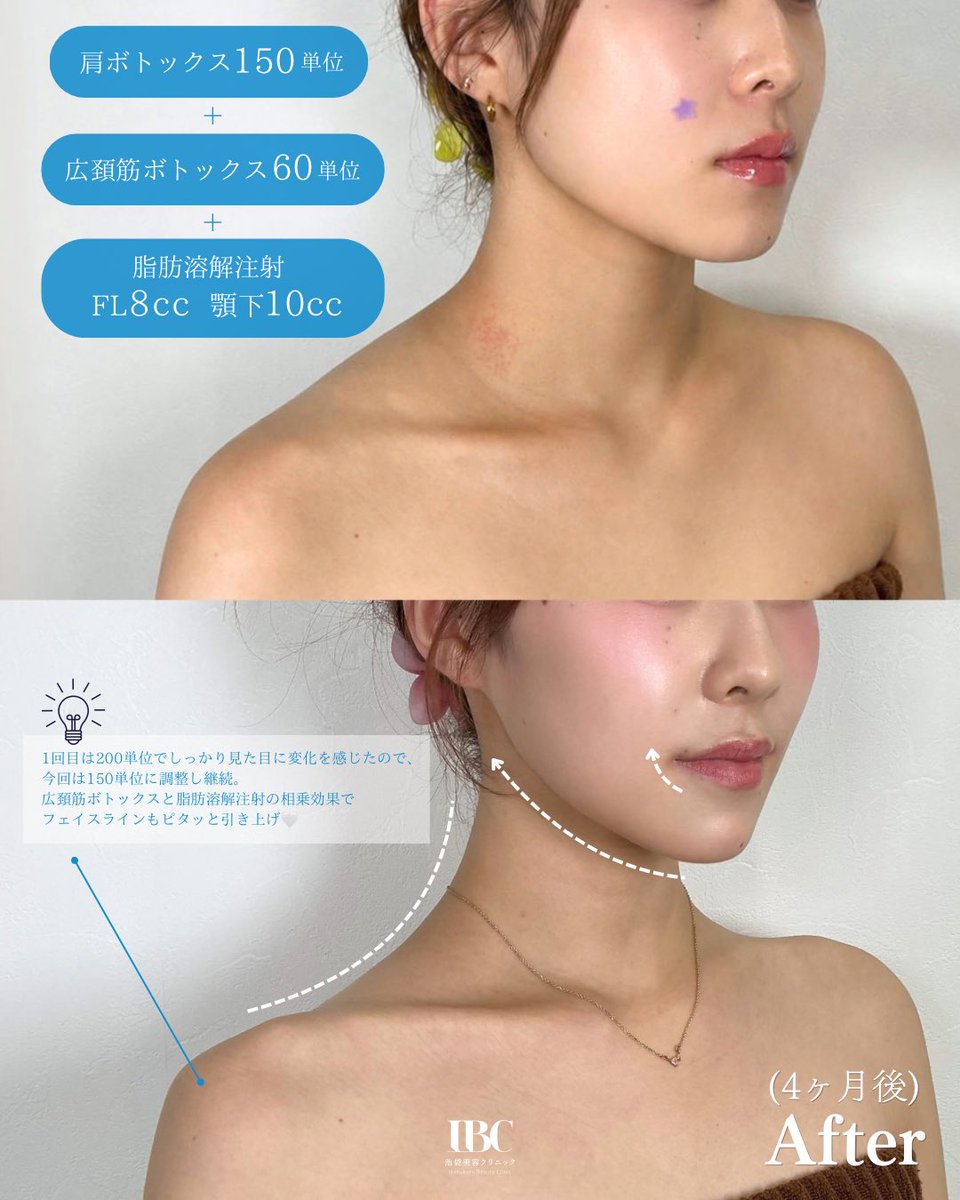 ibcbeautyclinic's tweet photo. 首は「肩ボトックス」＋「広頚筋ボトックス」で長くなる🩵

スタッフが2回目のボトックスを受けました！
肩周りの発達していた筋肉が落ち着き、華奢な印象に。
体重を落とさずとも、すっきりとした印象になります。
当院は安価ではありますが、デザインにこだわります💉 https://t.co/3vZWvp8oTn