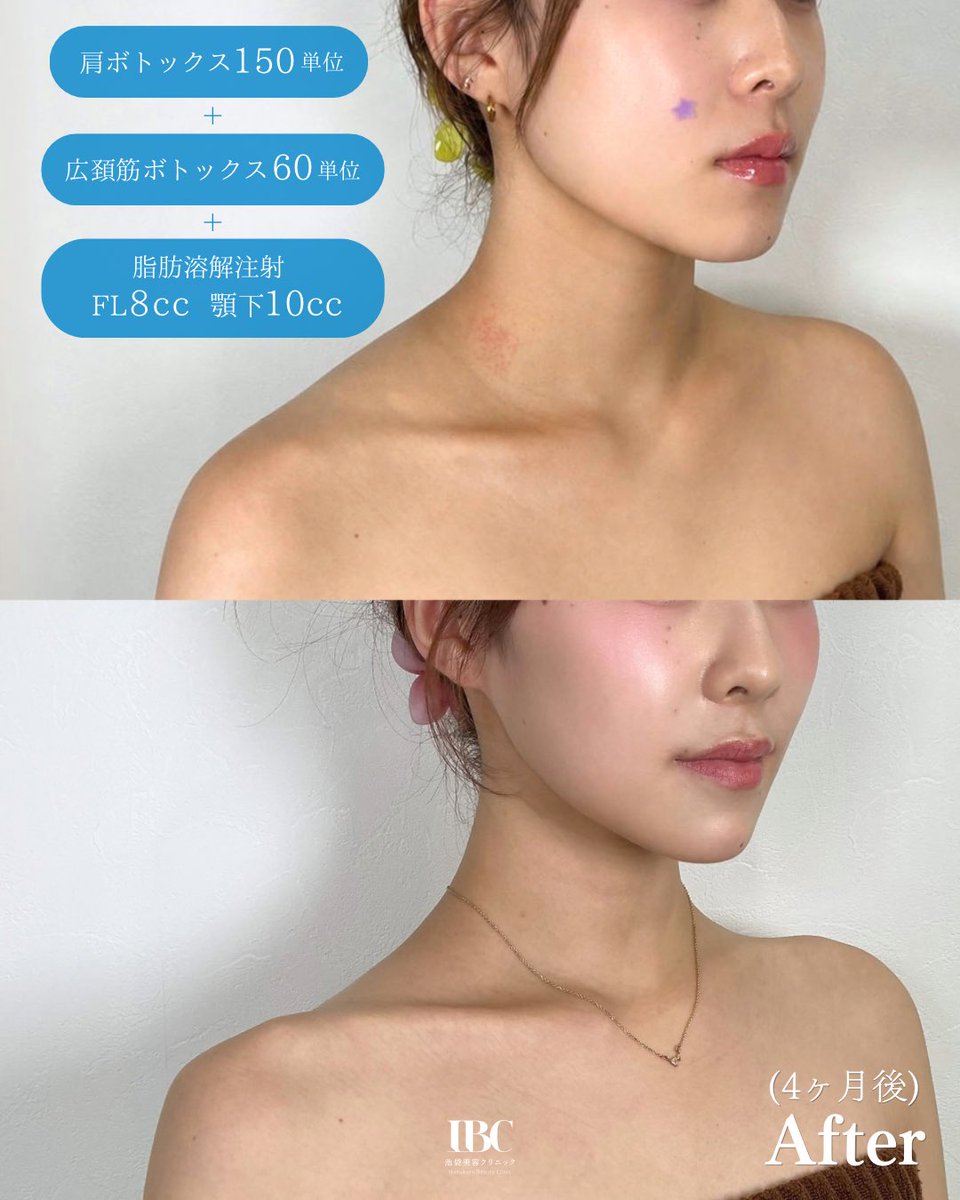 ibcbeautyclinic's tweet photo. 首は「肩ボトックス」＋「広頚筋ボトックス」で長くなる🩵

スタッフが2回目のボトックスを受けました！
肩周りの発達していた筋肉が落ち着き、華奢な印象に。
体重を落とさずとも、すっきりとした印象になります。
当院は安価ではありますが、デザインにこだわります💉 https://t.co/3vZWvp8oTn