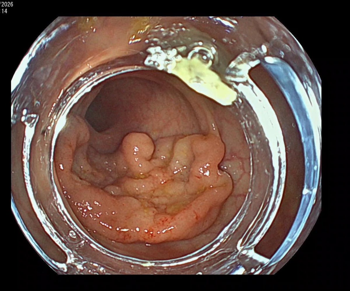lauraa_lexandra's tweet photo. Large fibrotic, very 🩸 rectal 🔪. Obviously 🤿🌊
Ambivalent about traction - Can't be bothered changing tension points. Yet...maybe traction deserves another chance
#ESD #ColorectalESD #advancedendoscopy https://t.co/8urr7gUAVH