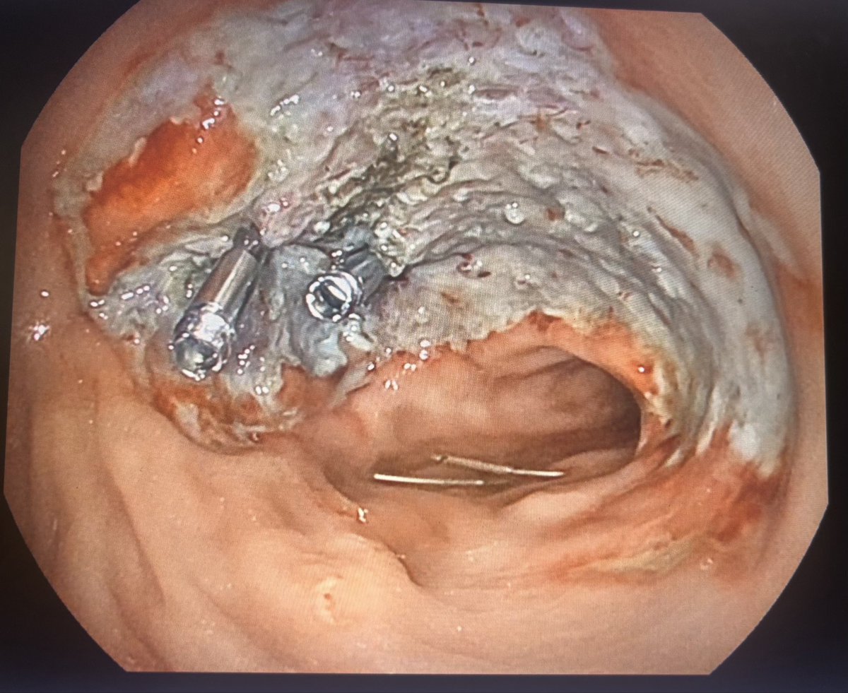 lauraa_lexandra's tweet photo. Large fibrotic, very 🩸 rectal 🔪. Obviously 🤿🌊
Ambivalent about traction - Can't be bothered changing tension points. Yet...maybe traction deserves another chance
#ESD #ColorectalESD #advancedendoscopy https://t.co/8urr7gUAVH