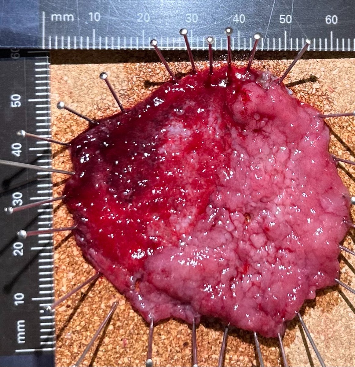 lauraa_lexandra's tweet photo. Large fibrotic, very 🩸 rectal 🔪. Obviously 🤿🌊
Ambivalent about traction - Can't be bothered changing tension points. Yet...maybe traction deserves another chance
#ESD #ColorectalESD #advancedendoscopy https://t.co/8urr7gUAVH