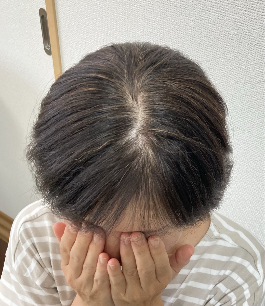 SaTo_qk's tweet photo. 最後のケモから21ヵ月、すっかり髪の毛も伸びたけど前髪とつむじが薄いのは抗がん剤あるある
そこで小さなヘアピースを買ってみたよ！
卒ウィッグの頃にも検討したけど、その時は地毛が短すぎて合わなかった
でも今はちょうど良い感じ！ビフォアフの写真、気になる方は見てみて〜 https://t.co/moSIi9890R