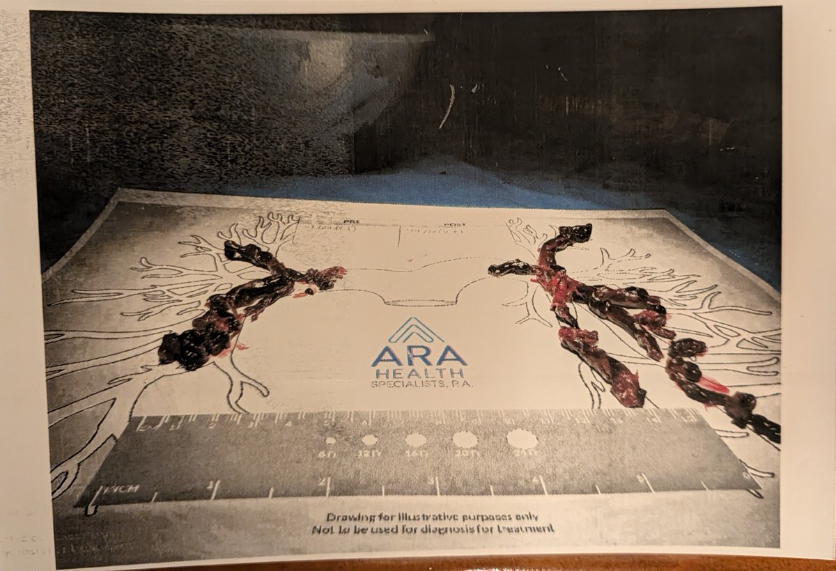 EthicalSkeptic's tweet photo. Lost a close loved one ...  Back from Turkey and turned around immediately to head to visit family and attend the service for him.

Blood clots in brain and throughout the lungs (below on lung schematic).

In 2023 we had 11 family members die of cancer, after having had 1 death from cancer the prior 6 decades...

The trolls lied to and gaslighted us all back then. Said I was lying. Said, "people die of cancer all the time." Not only stupid, but cruel as well. A dark spiritual rot in their soul.

Now everyone knows they were lying... but they continue unabated.

Now we have several dying from blood clots, one lost just days ago:

They told me these photos were faked
They told me that the morticians were lying
They told me this always happens we just did not know it
They told me Covid did this

Lie after lie after lie - all in the name of 'science'

The 35-year experienced doctor gasped when he saw these results.

The propagandist Pharma Trolls were full of shit, and have been all along. Threatening our families, threatening our employers...   Dirt in their souls.

I will NEVER trust a person who claims to 'represent science or the scientific method' again...

 it is just code for posssessing a license to lie... to pretend to be God over their fellow man...