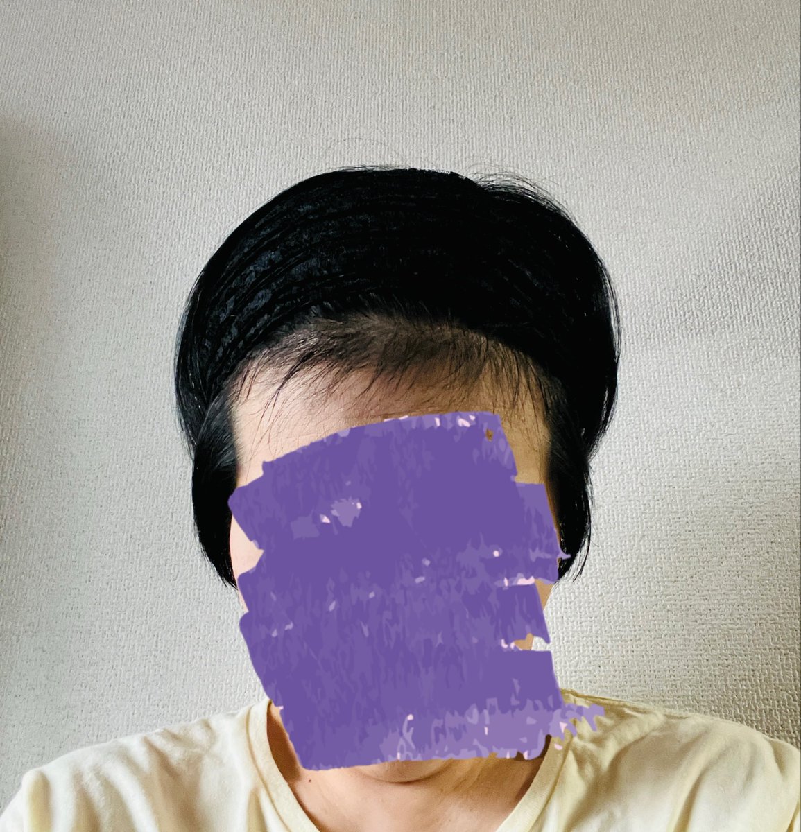lukarookow's tweet photo. 術前ラストケモから一年五ヶ月、ラストカドサイラから五ヶ月。
やっと伸びてきた前髪が鬱陶しく(なんて贅沢な！)、家でカチューシャで上げた時に出て来る生え際の短い髪何？て思ってたけど、これ最後まで生き残ってた部分がいつの間にか抜けて生えて来てる😳‼️
気付かなかったけどあの髪たちありがと🙏 https://t.co/NBMexZcyfC