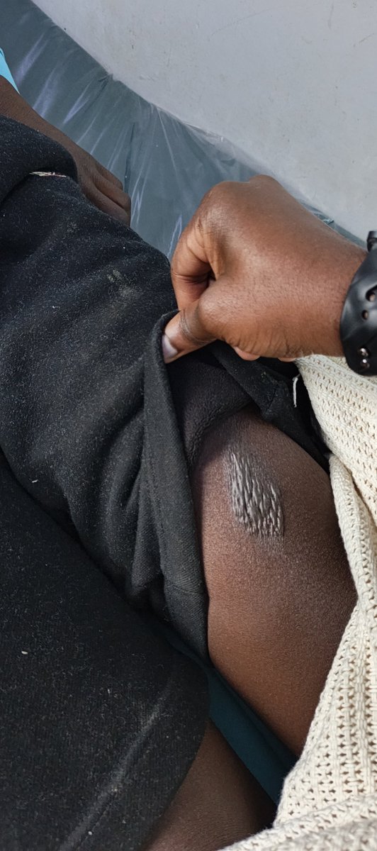 RevoltMankuyio's tweet photo. Mr Dictator Kasongo has released Collins Otieno. He was released last night and Dumped along Thika Road . He has been seriously injured his legs are burnt and he is unable to speak. Collins health has deteriorated. https://t.co/4eEc5zSWMs