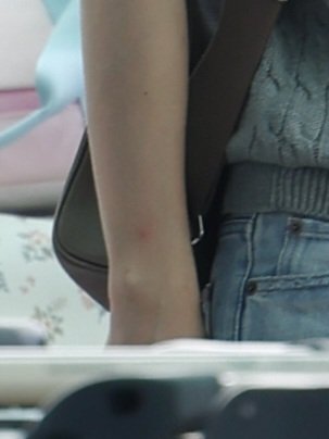 luvbaek9's tweet photo. 백현이 팔에 모기물렷나요 https://t.co/EU4OVoOtEH