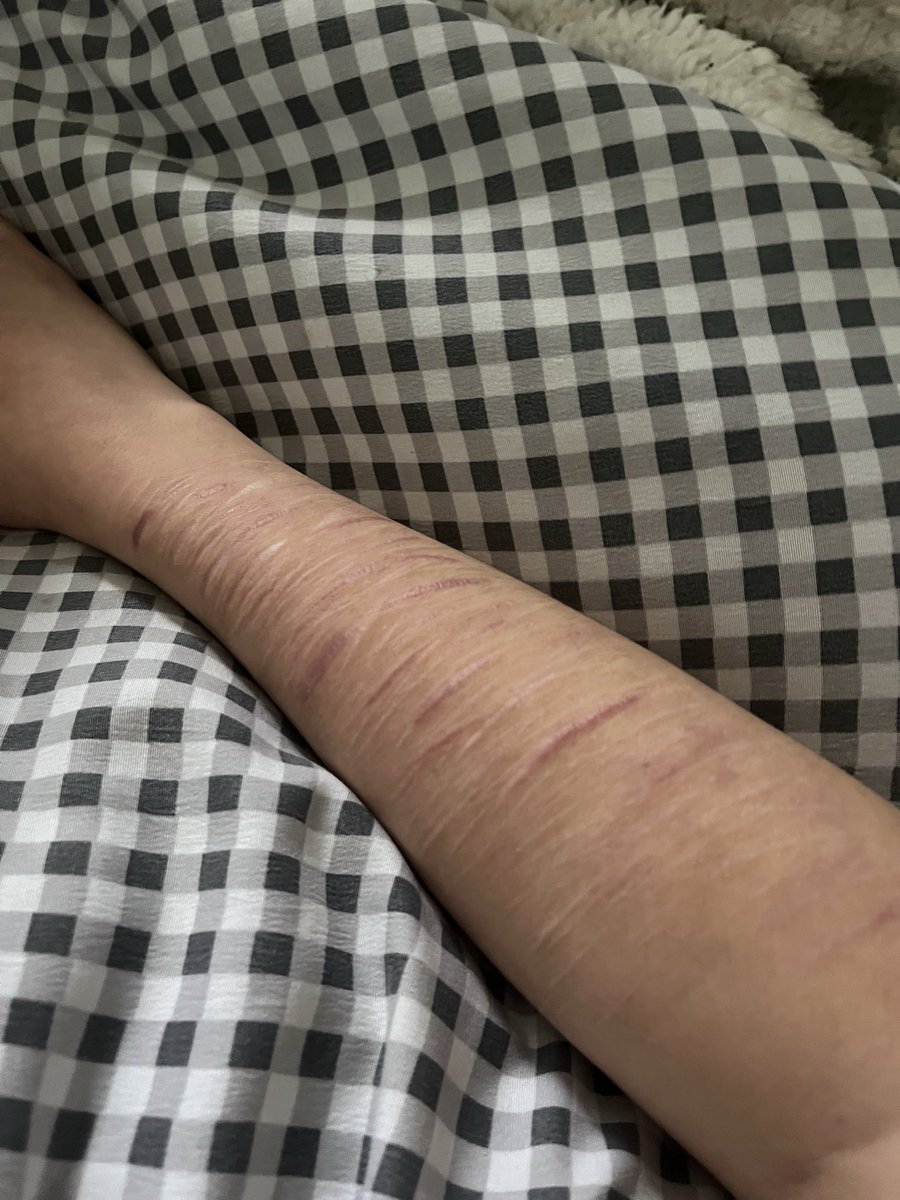 khloiex's tweet photo. my scars now and before 

ALL SFX, NOT REAL, SFX MAKEUP

#shwt #ventwt #shedtwt #moothunt〃・ #edtwt

┊┊┊┊⋆ ✧　 　 · 　 ✧　✵ ┊┊┊☆ *　　 * ⋆ ┊┊★ * ┊┊* . *　✦ ┊☆ ° ✧　 　 · ★* https://t.co/xeQDLe6VMG