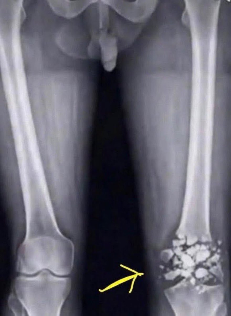 Deedawzz's tweet photo. 🚨Kylian Mbappe X ray is out, it’s not looking good at all https://t.co/liapD1MNPG
