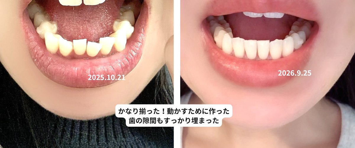 日本でインビザやって見事後戻りしたわい。韓国No.1歯列矯正部門 大賞を受賞してるクリニックでリベンジ矯正やってるんだけど、明らかに綺麗になったㅠㅠ下の歯が昔のマウスピースはまらないくらいガタガタになってたんだけど、かなり揃ってニヤニヤしてる...今回は最後に保定装置もつけてもらうんだ〜✊