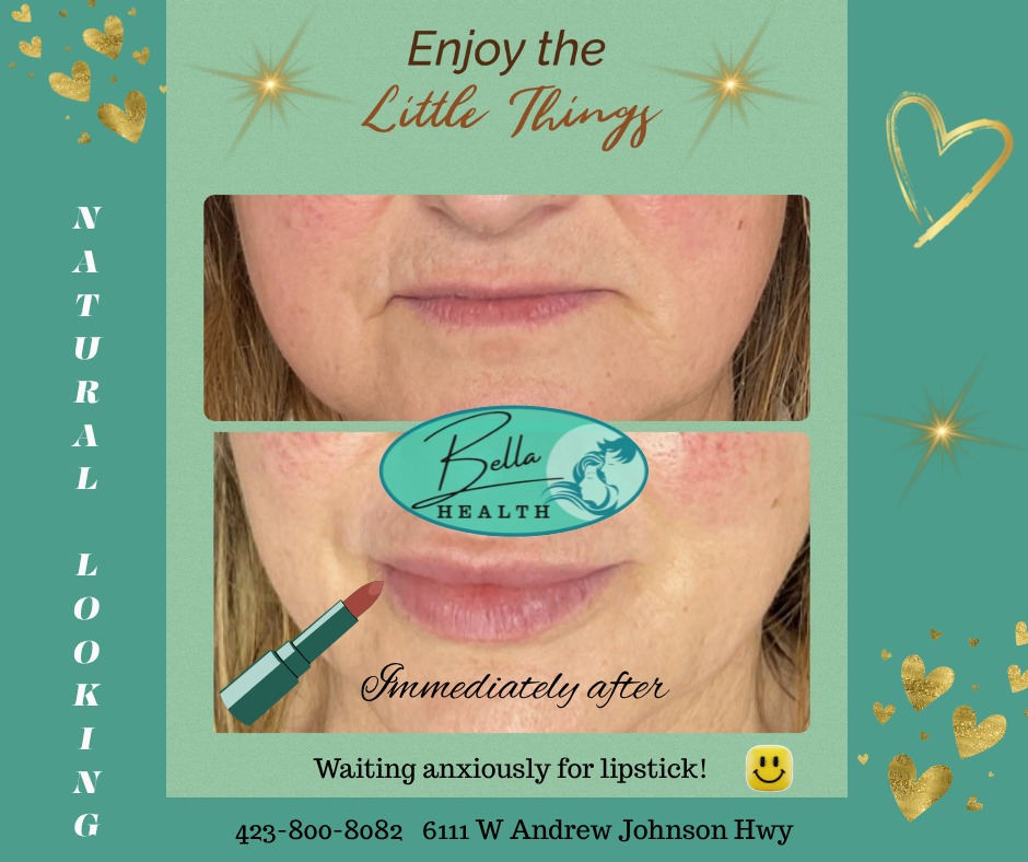 AlannaPickar's tweet photo. Facial rejuvenation, balancing, and lip filler by Cindy. The patient is delighted! We love putting smiles on faces. Benefits
1. Enhanced appearance
2. Natural-looking results
3. Fast recovery, if needed
4. Increased lip volume and facial balance https://t.co/6KYNqmurrQ