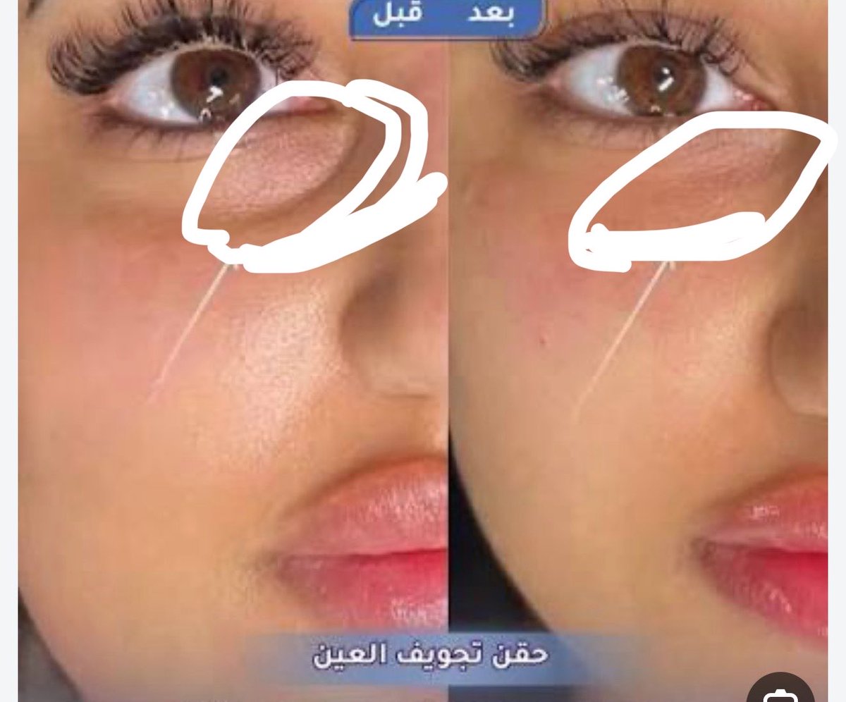 Ene3gn's tweet photo. @hvs_ll @Jujuinpariis هذي كسرة العين https://t.co/A3eIUYyl1B