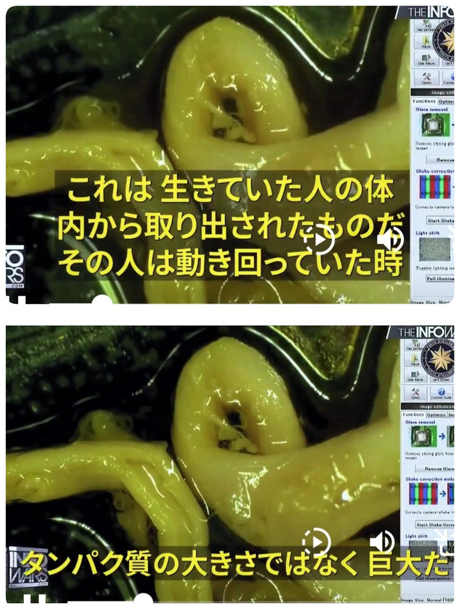 binbou415's tweet photo. [なぜ何年も経ってから重症になるのか]
ワクチンの遅効性毒主役の2人は人工ヒドラとm-RNAです。
人工ヒドラは鍾乳石原理で血液中の���ンパク質を集積し高分子繊維を形成します。食べ物にも寄りますが数年かかります。
一方m-RNAによる遺伝子組換えは細胞更新の周期に乗って拡散します。数年かかります。 https://t.co/n4O2RE9gaO