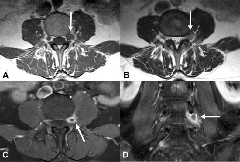 cad1em's tweet photo. 硬膜外静脈血栓epidural vein thrombosis

普段気づけるとしたらSTIRかな…axialのT2WIとかだと自信ない

PMID 37868005
#RdiagTips https://t.co/fsmLyeUEVp