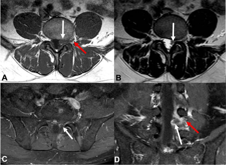 cad1em's tweet photo. 硬膜外静脈血栓epidural vein thrombosis

普段気づけるとしたらSTIRかな…axialのT2WIとかだと自信ない

PMID 37868005
#RdiagTips https://t.co/fsmLyeUEVp