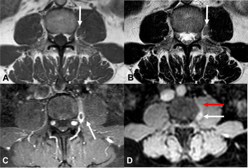 cad1em's tweet photo. 硬膜外静脈血栓epidural vein thrombosis

普段気づけるとしたらSTIRかな…axialのT2WIとかだと自信ない

PMID 37868005
#RdiagTips https://t.co/fsmLyeUEVp