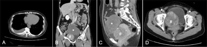 cad1em's tweet photo. fibrothecoma（＊）でMeigsと思ったら（＃）は悪性SFTだった症例

PMID 37868006
#RdiagTips https://t.co/CaUB6dSbcl