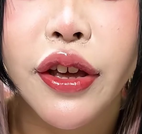 hmweum's tweet photo. まじでエレメちゃんに人中短縮した美容外科医、メス握っちゃいけないだろこれ。

直美がやったとしか思えない仕上がりだし、そりこんなん顔に傷付けられたら自信無くなるの当然だって。

形成外科専門医持ってない闇医者まじ大概にして欲しい。。。 https://t.co/fv2tYvN7rw