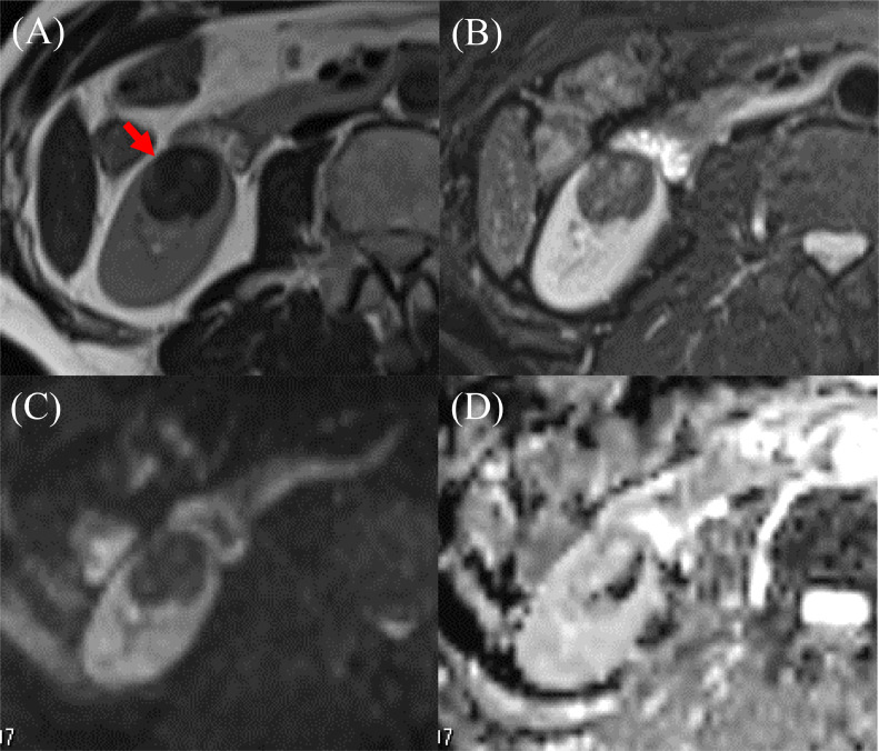 cad1em's tweet photo. renomedullary interstitial cell tumor腎髄質間質細胞腫瘍RMICT

旧medullary fibroma髄質線維腫
多くは5mm未満で、剖検で非常によく見つかる（肺のMPMNみたいな立ち位置？）
T2WI低信号でゆっくり造影され、大きいとpapillary RCCなどとの鑑別厳しい

PMID 37886730
#RdiagTips https://t.co/PeJAcYD5nW