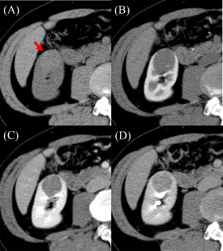 cad1em's tweet photo. renomedullary interstitial cell tumor腎髄質間質細胞腫瘍RMICT

旧medullary fibroma髄質線維腫
多くは5mm未満で、剖検で非常によく見つかる（肺のMPMNみたいな立ち位置？）
T2WI低信号でゆっくり造影され、大きいとpapillary RCCなどとの鑑別厳しい

PMID 37886730
#RdiagTips https://t.co/PeJAcYD5nW