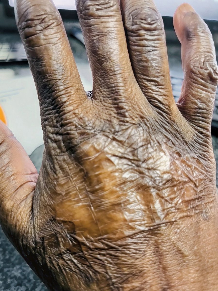 Misst_Thembs's tweet photo. Hands of A  survivor https://t.co/UnFLuW3nSn