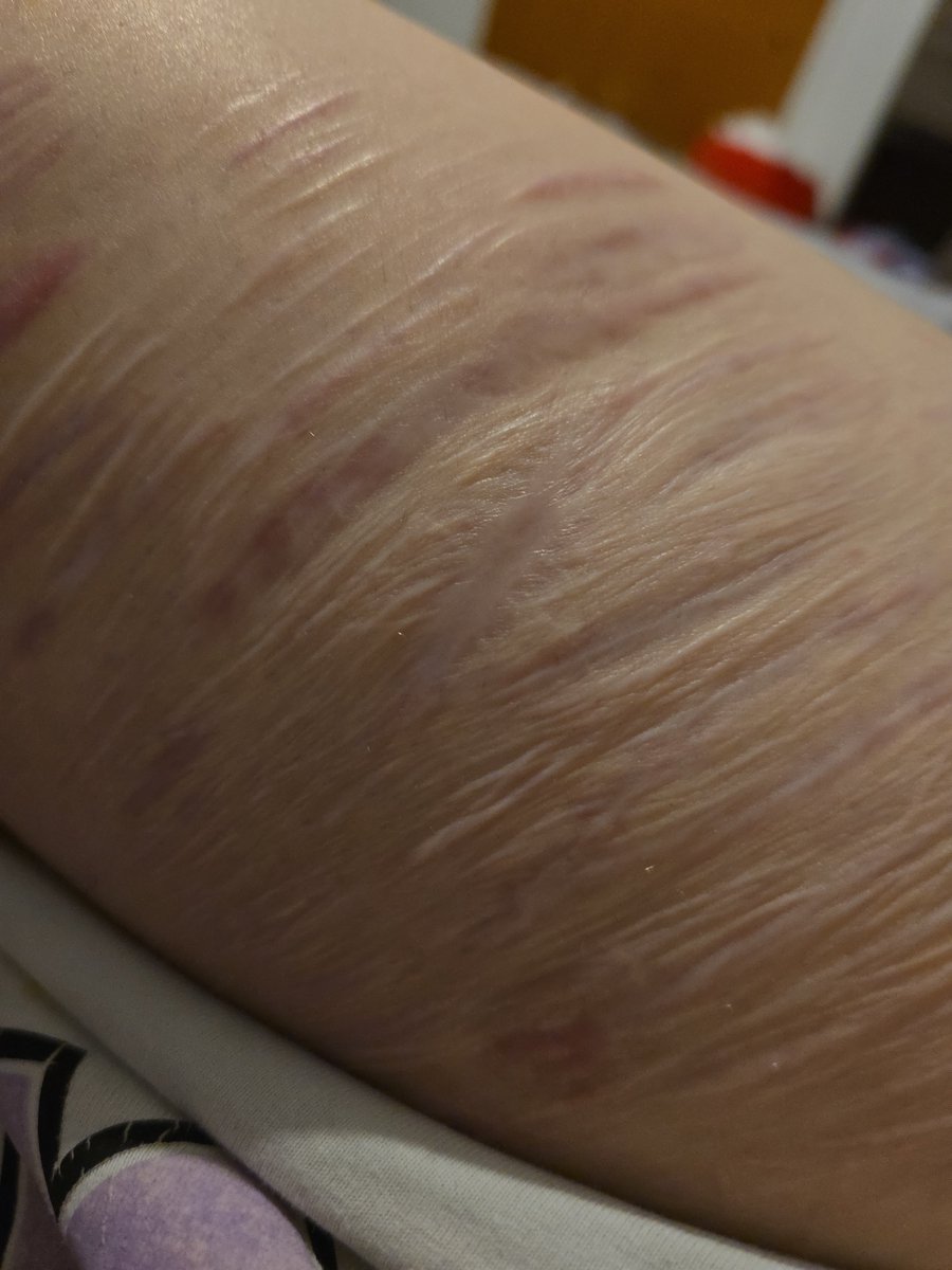 itttskayla's tweet photo. @Itzzz_yumi00 Honestly i should have gotten it stitched but i was high for thr first time on a benzo and I missed the window to get stitches, its gonna take like 3 months to fully heal unfortunately here's a pic of a scar of what was a similarly sized cut https://t.co/2jAZKAIV19