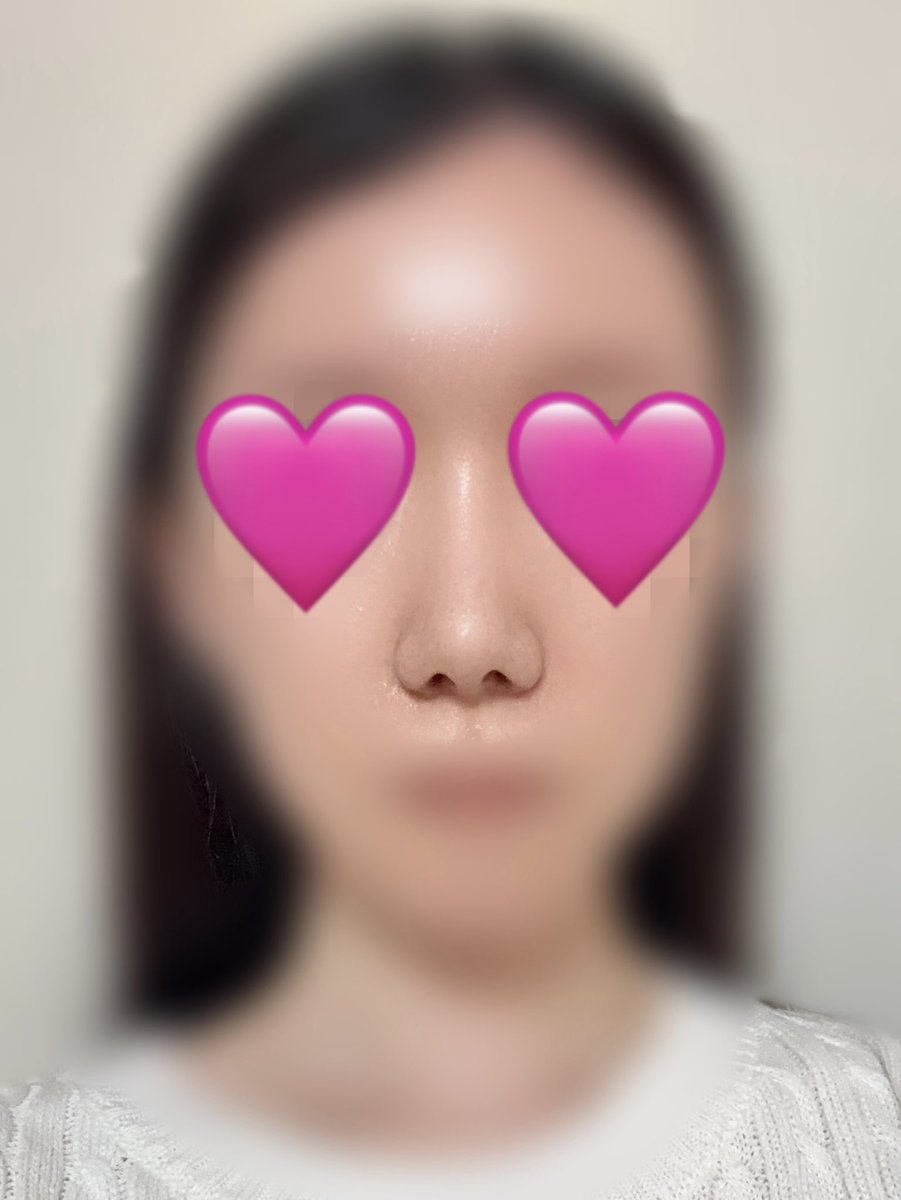 nun____46's tweet photo. ビギン美容外科さんで鼻整形3ヶ月経過しました👃
感染や不具合なく3ヶ月無事に過ごせました！
今月は経過診察に行き、状態良好とのこと◎
とても対応が良く、安心して過ごせています😌
団子鼻が改善されて嬉しいです🥰

#ビギン美容外科 #イジュチョル院長 #鼻整形 #鼻フル https://t.co/ii5TEmvnl5