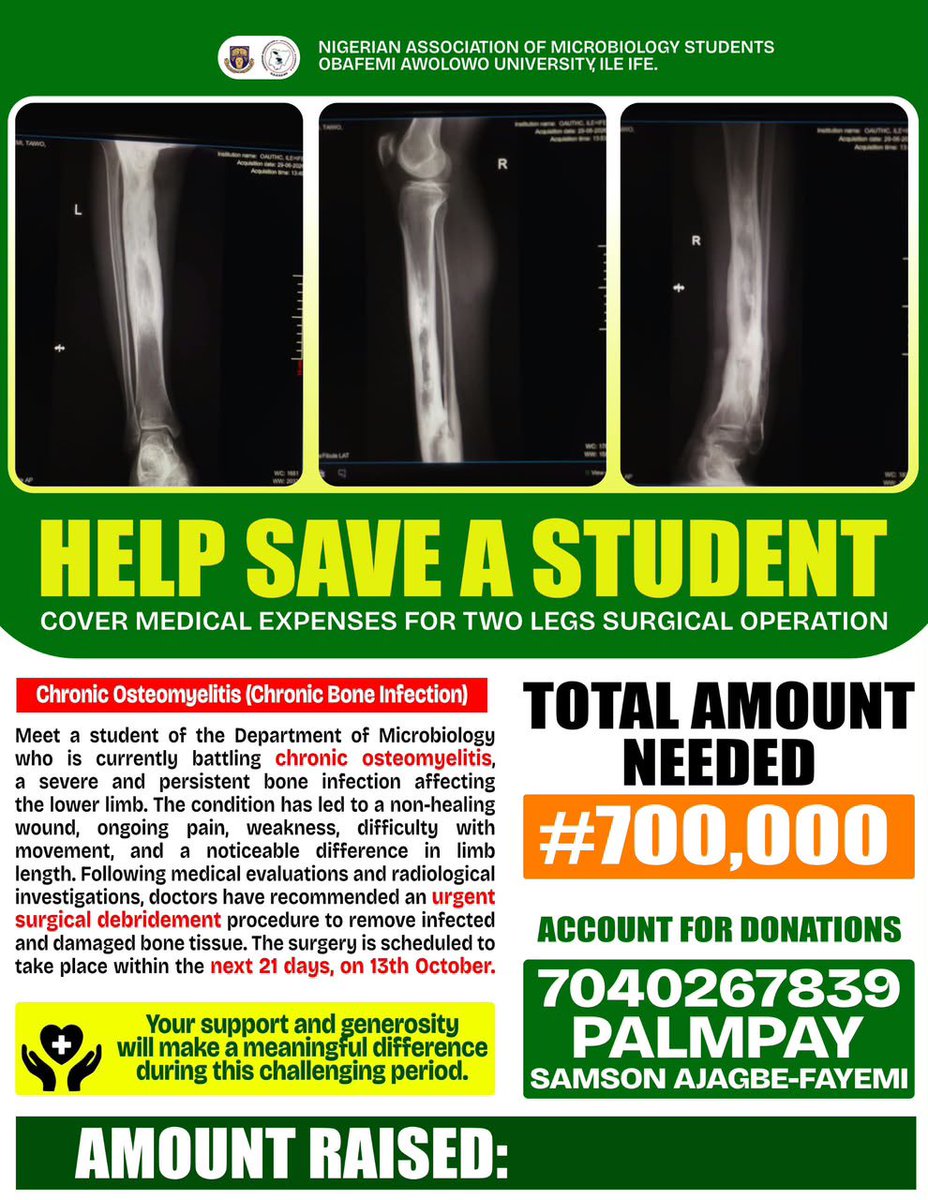 ayodimeji_taiwo's tweet photo. Dear @cuppymusic, please lend your voice to #HelpSaveAStudent! 

A student urgently requires a two-leg surgical operation to recover and return to school. Your support or repost can make all the difference in saving this young life.

#MedicalEmergency #CuppyFoundation https://t.co/Bv94nxszH6