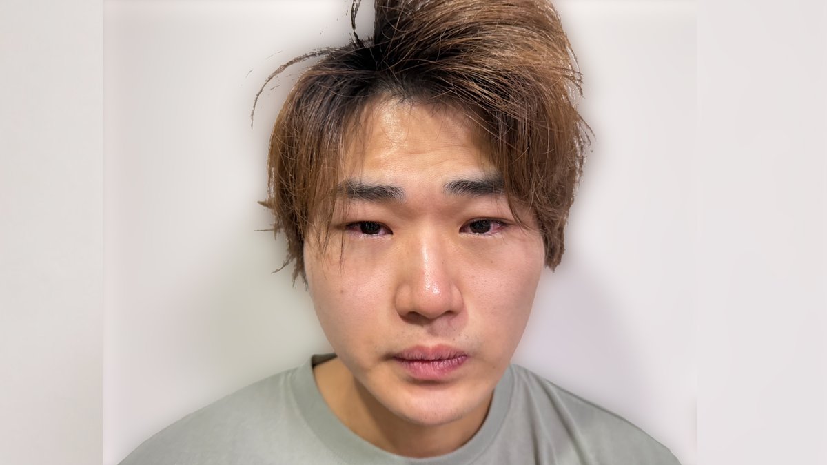 suzushoto_desu's tweet photo. 弟の目が謎の感染..緊急で病院にいったら... ￥

https://t.co/qD4VVMuxyA @YouTubeより 

拡散よろしくおねがいします https://t.co/fUZRl9CMZL