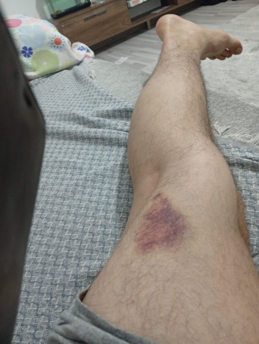 VetHekimSen's tweet photo. Antalya  İli Elmalı İlçe Tarım ve Orman Müdürlüğünde görev yapan Veteriner Hekim Ömer Kocabaş, büyükbaş hayvanlarda şap aşılaması sırasında iş kazası geçirdi.

Meslektaşımıza geçmiş olsun dileklerimizi sunuyoruz.

Sahada bulaşıcı hastalıklarla iç içe, fiziki yaralanma riski çok yüksek koşullarda görev yapıyoruz. Veteriner hekimlik, mesleğin doğası gereği sürekli ve kaçınılmaz yüksek risk içeren bir meslektir. Yaşanan bu kaza, talep ettiğimiz hakların gösterilecek bir gerekçesi değil; zaten var olan ağır ve riskli çalışma koşullarının somut bir örneğidir.

Fiili hizmet süresi zammı (yıpranma payı), münferit kazalardan değil; mesleğin özünde var olan kalıcı, sürekli ve yüksek risklerinden kaynaklanmaktadır. 

Bu nedenle veteriner hekimlere, veteriner sağlık tekniker ve teknisyenlerine fiili hizmet süresi zammı (yıpranma payı) tekrar verilmelidir. 

Fiili Hizmet Süresi Zammı Davamızın 2. duruşması 13.10.2026 tarihinde Adana’da yapılacaktır!

#VeterinerHekimSendeyiz 
#VeterinerHekimSenYıpranırsın 
#FiiliHizmetZammıHaktır  

@tcbestepe @TCTarim @cbsbb @RTErdogan @ibrahimyumakli @saglikbakanligi @AhmetGumen @drmemisoglu @HMBakanligi @memetsimsek